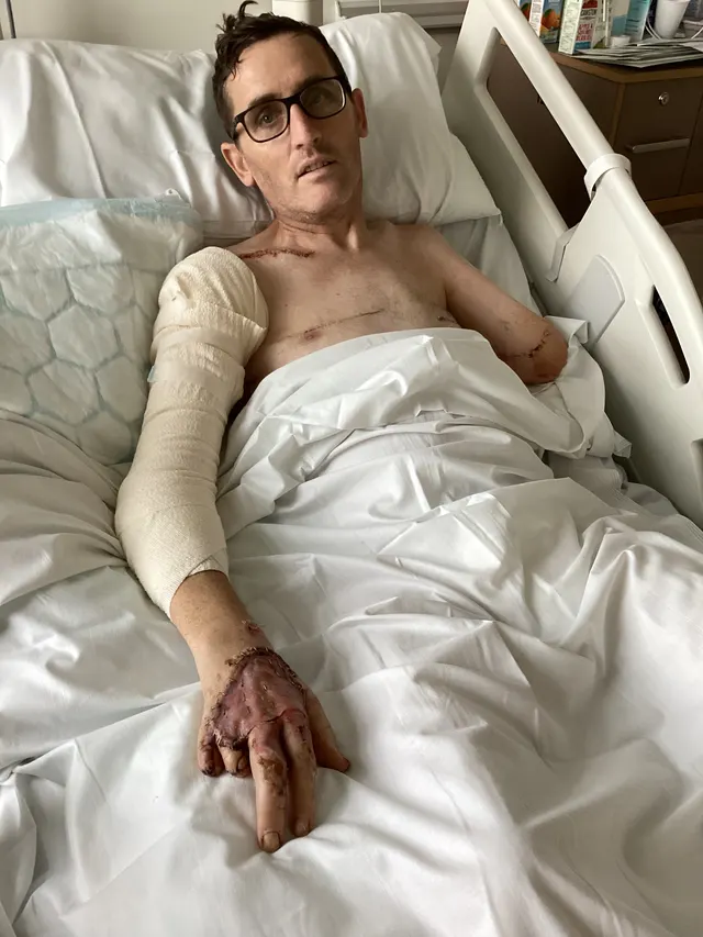 Simon in a hospital bed after the accident, his arm bandaged and his hand stitched, the other arm amputated