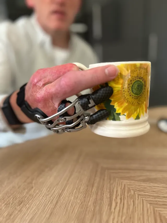Simon’s hand, fitted with prosthetic fingers, holding a mug decorated with sunflowers